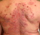 Bevestiging van de werkzaamheid van rituximab als eerstelijnsbehandeling voor pemphigus foliaceus 