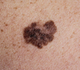 La campagne d'Euromelanoma cible les Belges sujets à une récidive de cancer de la peau