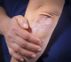 Werkzaamheid van deucravacitinib na een jaar bij psoriasisartritis