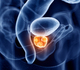 Prostate : le PSA réinterprété par une IA hybride pour suivre l’évolution tumorale