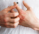 Dermatite atopique: une atteinte de la qualité de vie